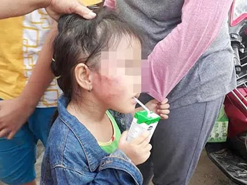 Vụ bé gái 5 tuổi bị tát tím mặt: Cô giáo đánh trẻ nói gì?